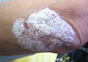 乾癬の皮膚症状(左肘)の1例